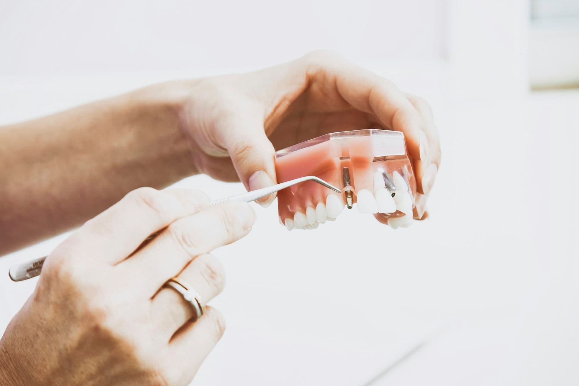 Detail van tandtechnisch werk met implantaten