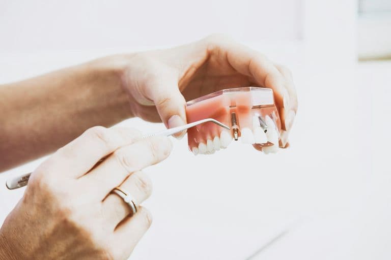 Detail van tandtechnisch werk met implantaten